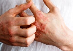 عارضه دردناک خارش پوست + درمان خانگی