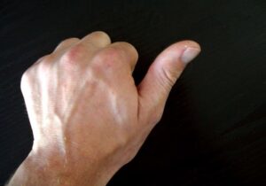 نشانه خطرناک لرزش انگشت شست