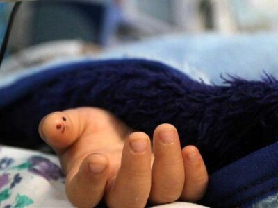 ابتلای نوزادان به بیماری که هیچ‌کس فکرش را هم نمی‌کند