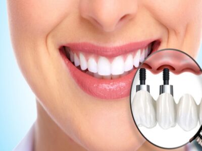 بررسی هزینه ایمپلنت دندان در کلینیک ‌های دندانپزشکی