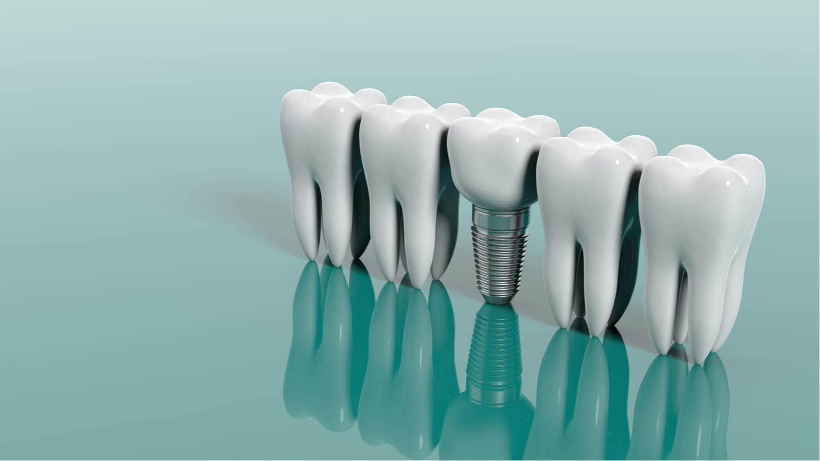 بررسی هزینه ایمپلنت دندان در کلینیک ‌های دندانپزشکی