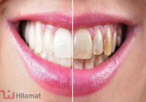 ۷ روش های خانگی سفیدشدن دندان
