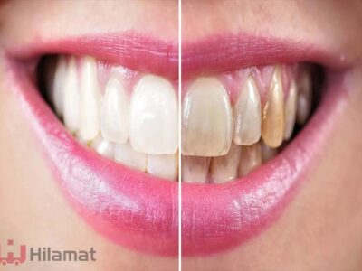 ۷ روش های خانگی سفیدشدن دندان