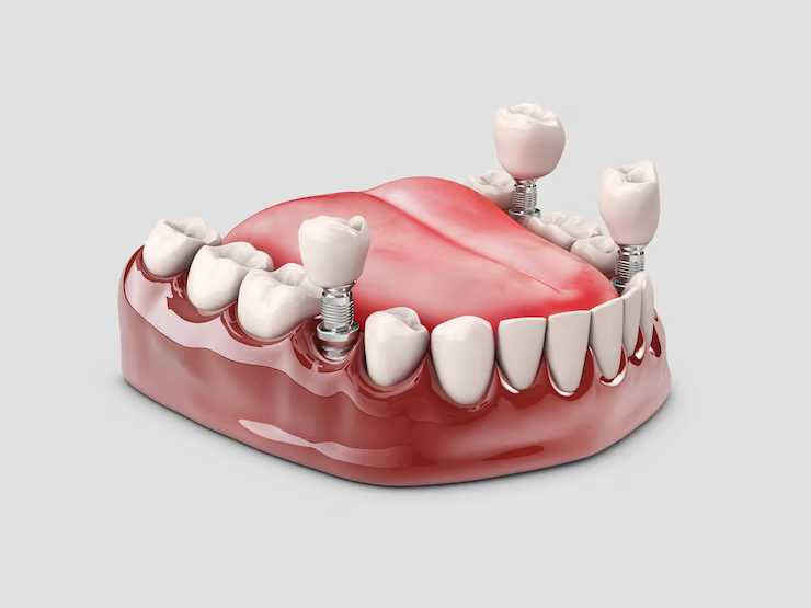 پروتز دندانی پارسیل