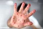هشدار بیماری | اتباع افغان و پاکستان سوغاتی تازه آوردند !