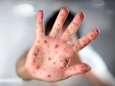 هشدار بیماری | اتباع افغان و پاکستان سوغاتی تازه آوردند !