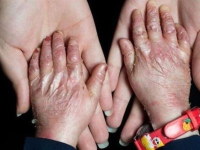 گوشهای از مصائب بیماران پروانهای/دستهایی که با پانسمان گره خوردهاند/ زندگی با بیماری نادر!